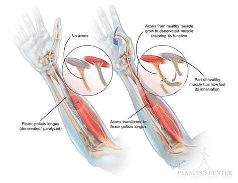 Nerve Transfer — Paralysis Center