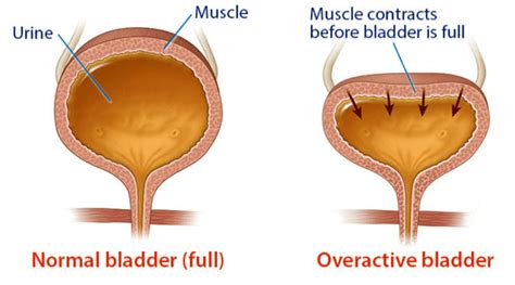 Overactive Bladder