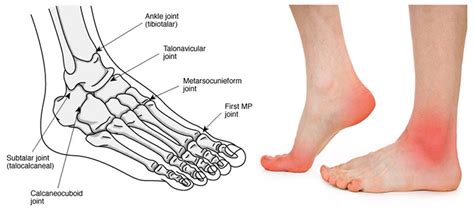 Arthritis of the Foot - Chicago Foot Care Clinic