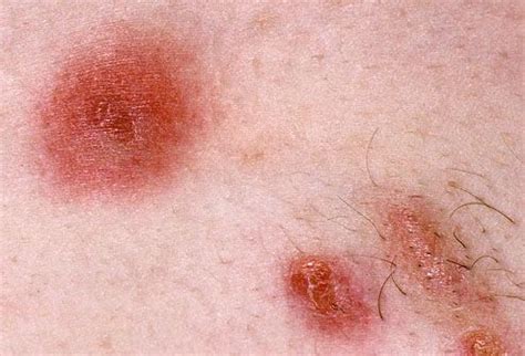 MRSA Symptoms, Causes,What it Looks Like, Treatment