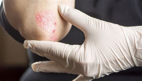 A recurring, itchy, burning rash in a patient taking beta-blockers- Clinical Advisor