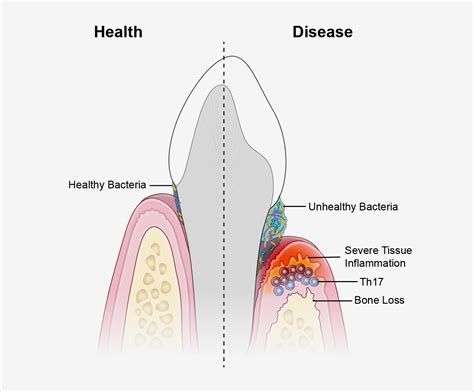 Researchers identify immune culprits linked to inflammation and bone ...