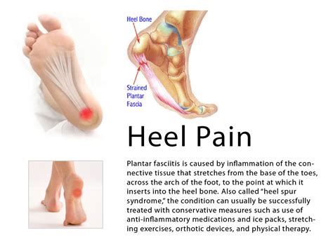 Calcaneal spur Heel pain Homeopathic Treatment