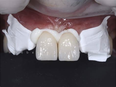 Zirconia crowns cementation with resin-modified glass-ionomer cement - MyZerodonto