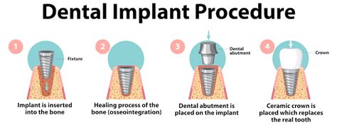 Dental Implant Procedure - Maltepe Dental Clinic