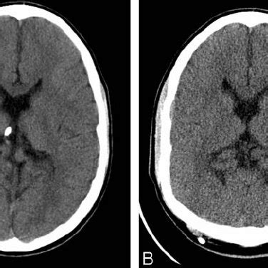 A,B , Diagnostic acceptability of low-dose CT studies. | Download ...