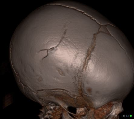 Pediatric ceiling fan-induced head injury | Radiology Case | Radiopaedia.org