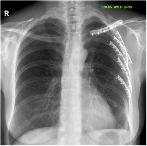 Anaesthetic and surgical management of rib fractures - BJA Education