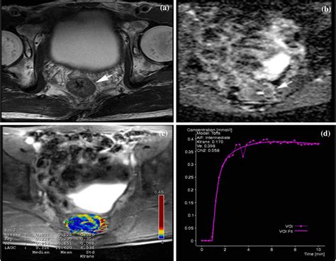 72-year-old man with Mr-detected extramural venous invasion (mrEMVI ...