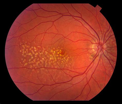 What Shots Are Given For Macular Degeneration at April Richard blog