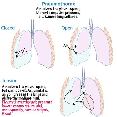 Pneumothorax Causes