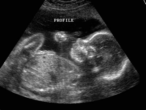 Ultrasound bill Challenged in LA Federal Court; Touted in Wash Post ...