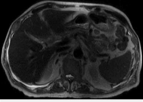 [PDF] Stauffer Syndrome as the Initial Presentation of Advanced Metastatic Prostate Cancer ...