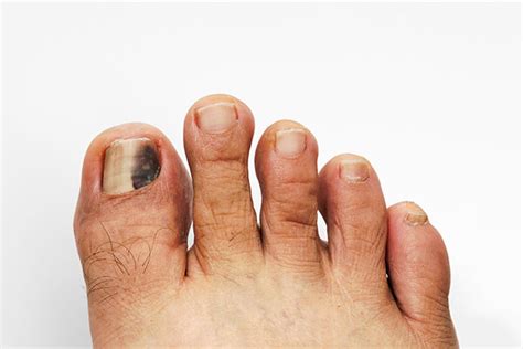 Black Spot On Toenail: Learn About Its Development And Treatment