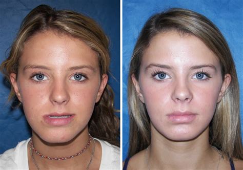 Before & After Case 12 mandible surgery - Larry M. Wolford, DMD