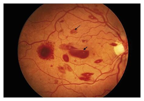 Retinal Hemorrhage; Hemorrhage, Retinal