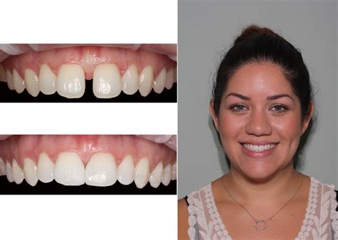 Palm Beach Smiles - Cosmetic Dentistry & 6 Month Braces: Do You Mind ...