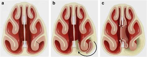 Figure 2 from Repair of nasal septal perforation using a simple ...