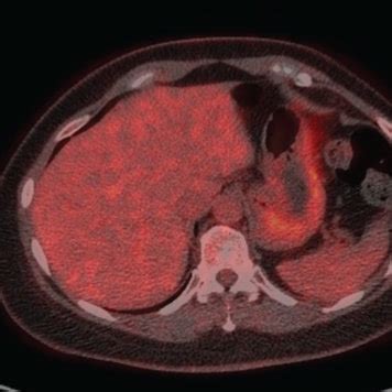 Biopsy of metastatic lesion involving the portacaval lymph node. | Download Scientific Diagram