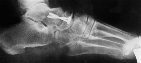 Talonavicular Joint