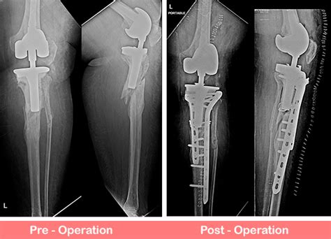 Revision Total Knee Replacement (Rotating Hinge Knee) | Dr. Shekhar Agarwal