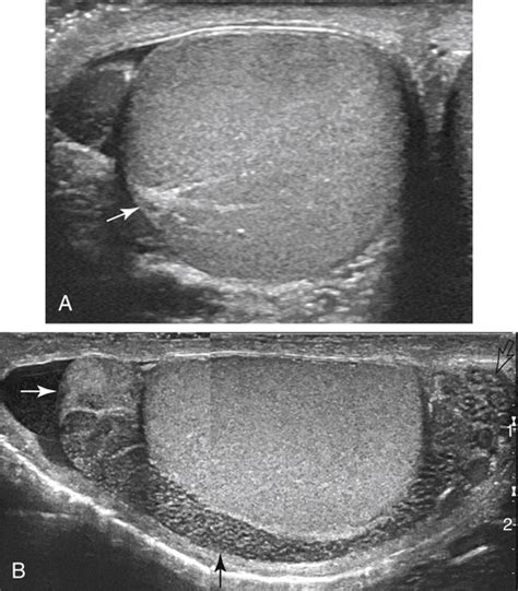 Scrotal Mass and Scrotal Pain | Radiology Key