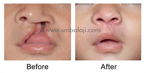 Cleft lip surgery in India | No.1 Best Cleft Lip Surgeon