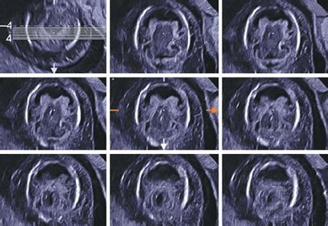 Holoprosencephaly at 12 weeks of gestation. Tomographic ultrasound... | Download Scientific Diagram