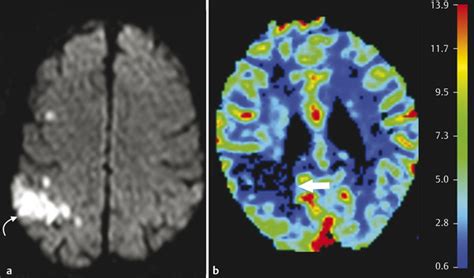 Diffusion Weighted Imaging in Vascular Pathology | Radiology Key