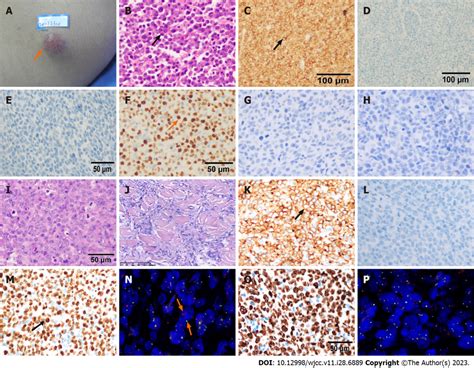 Morphologic and immunohistochemical characterization of this patient's ...