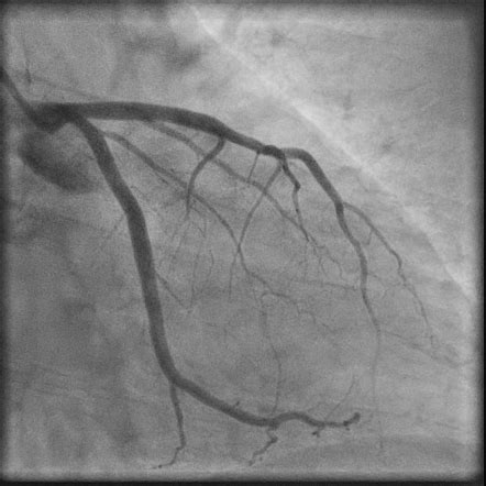 Right marginal artery | Radiology Reference Article | Radiopaedia.org