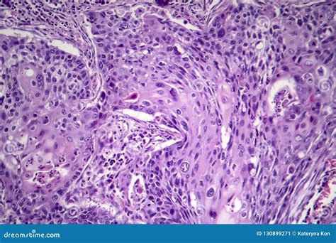 Squamous Cell Carcinoma of the Lung Stock Image - Image of cancer, eosin: 130899271