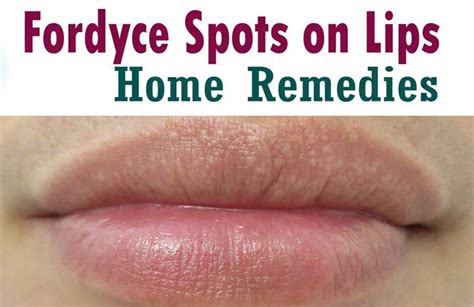 Steadyhealth Fordyce Spots On Lips Cure | Lipstutorial.org