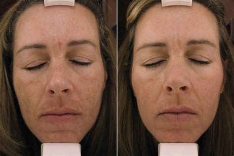 Melanage – The Secret of Melasma Treatment | Lower Gwynedd, PA Patch