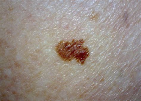 Early stage melanoma cancer pictures | Symptoms and pictures