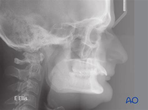 Mandibular retrognathism