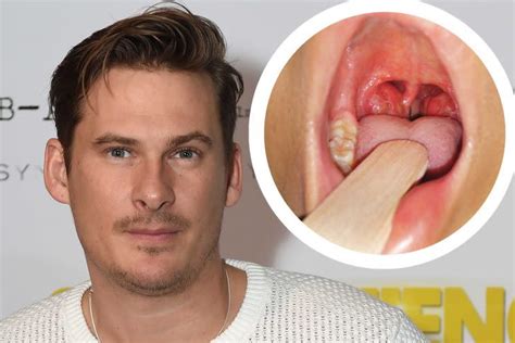 What is quinsy disease? Lee Ryan's tonsillitis complication explained