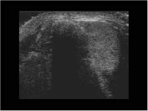 Head and Neck | 4.1 Thyroid gland : Case 4.1.1 Thyroid congenital abnormalities | Ultrasound Cases