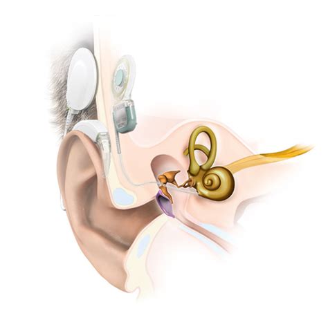 Cochlear Implants & MRI Safety | Blog