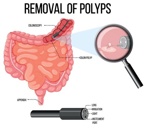 Colon polyps treatment – Redding Gastroenterology