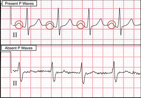 ECG INTERPRETATION FOR NCLEX: PART TWO - The Nurse Speak