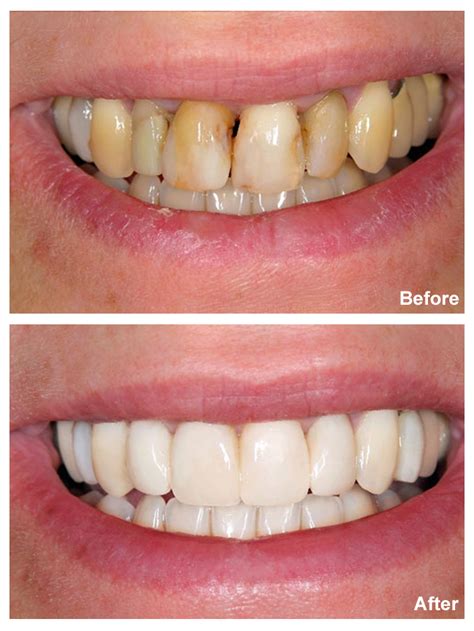 Are Veneers Bad For Your Teeth? - Sedation and Implant Dentistry of ...