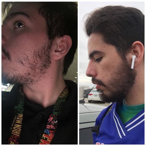 Minoxidil Beard Growth Before And After