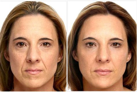 BOTOX BEFORE AND AFTER - Desmotsdart | image-blog