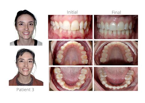 Adult Braces Patient 3 After - Orthodontic Arts