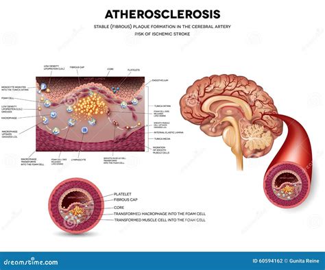 Plaque Formation In Artery Vector Illustration | CartoonDealer.com #10836470