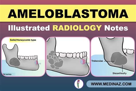 Ameloblastoma Radiology: Dental Radiology Notes