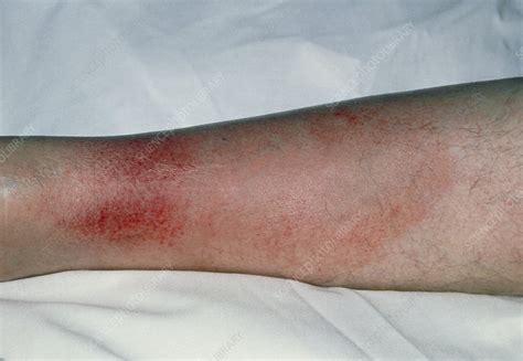 Cellulitis on the leg - Stock Image - M130/0322 - Science Photo Library