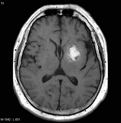 Hemorrhagic Stroke Mri