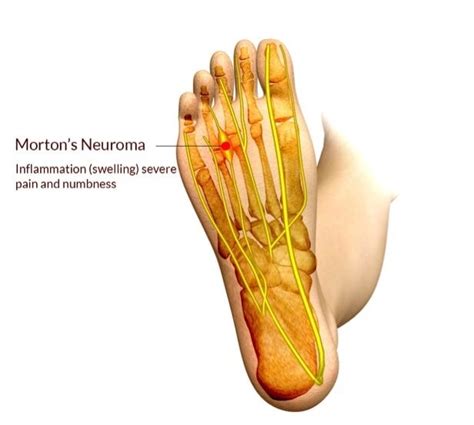 Morton's Neuroma | Podiatrist NYC Downtown | Step Up Footcare